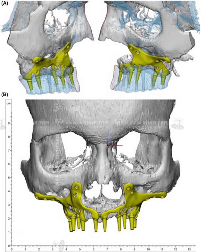 Cấy ghép Implant cá nhân hóa là giải pháp sau cùng cho bệnh nhân có tình trạng tiêu xương nghiêm trọng Cấy ghép Implant cá nhân hóa là giải pháp sau cùng cho bệnh nhân có tình trạng tiêu xương nghiêm trọng