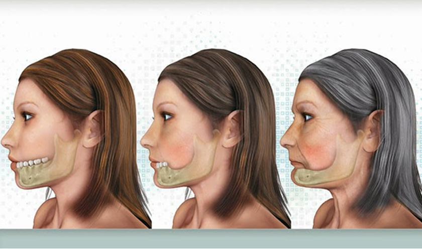 Hình ảnh bị tiêu xương ổ răng khi bị mất răng