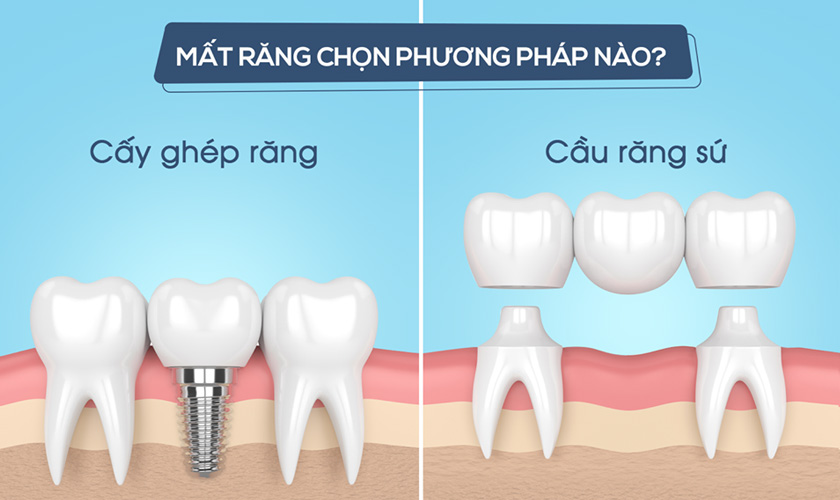 Cấy ghép Implant không cần mài hay xâm lấn đến các răng kế bên