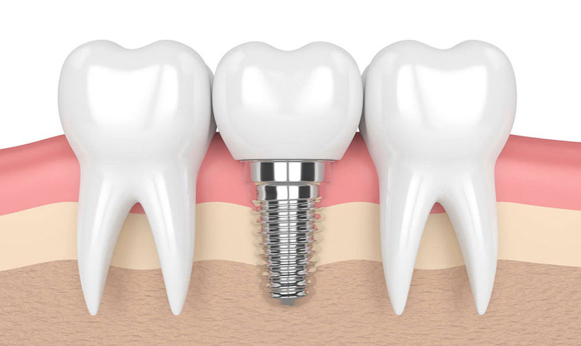 Chi phí implant tùy thuộc vào loại implant và răng sứ mà bạn lựa chọn