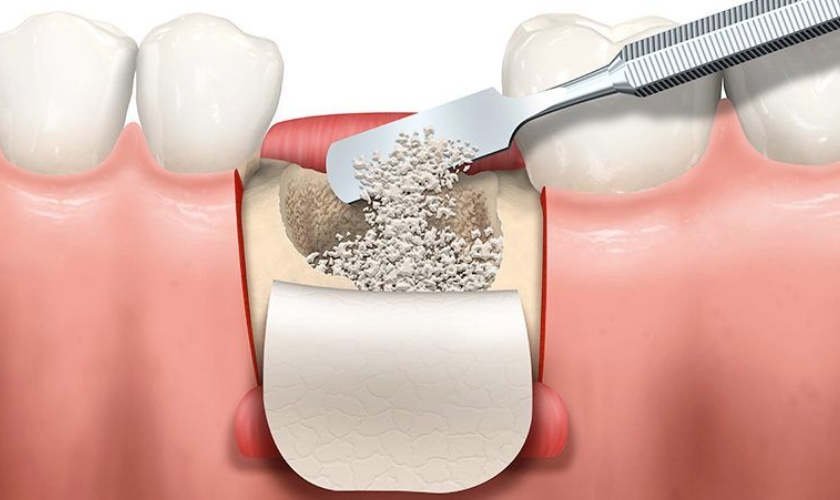 Trong trường hợp ghép xương thì sẽ tính thêm chi phí ghép xương