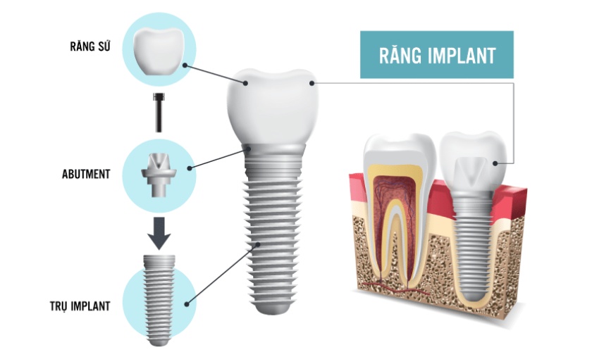 Giá implant phụ thuộc vào thành phần cấu tạo nên implant