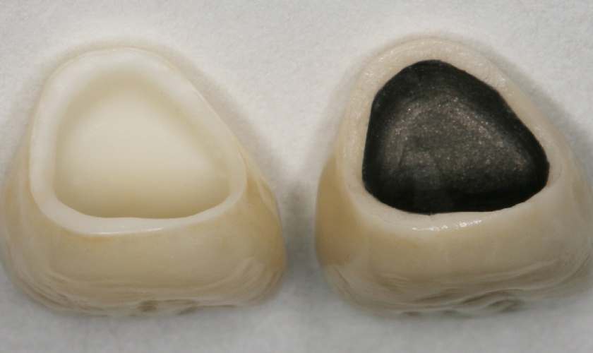 Răng sứ kim loại có giá thấp hơn răng toàn sứ