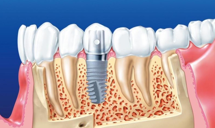 Giá răng implant sẽ phụ thuộc vào loại trụ implant mà bạn lựa chọn Giá răng implant sẽ phụ thuộc vào loại trụ implant mà bạn lựa chọn