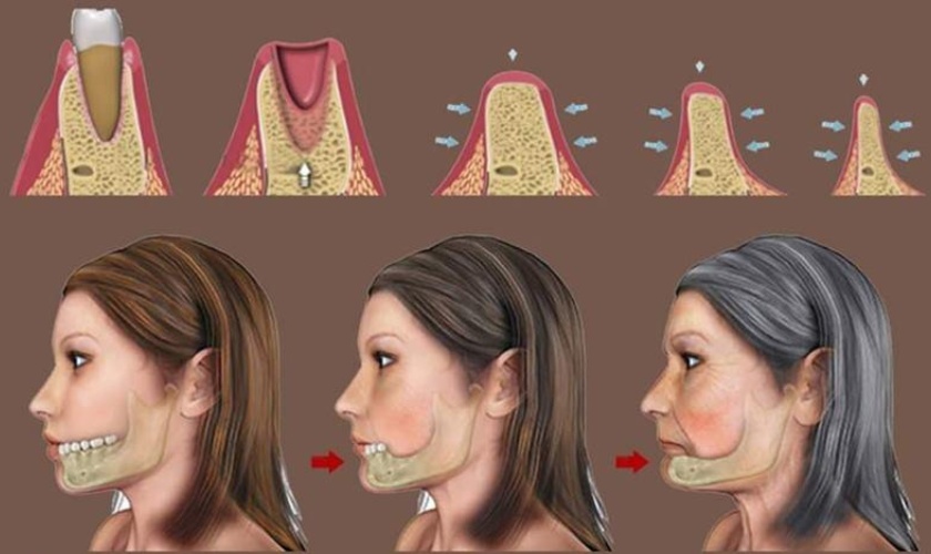 Implant giúp ngăn ngừa tiêu xương hiệu quả Implant giúp ngăn ngừa tiêu xương hiệu quả