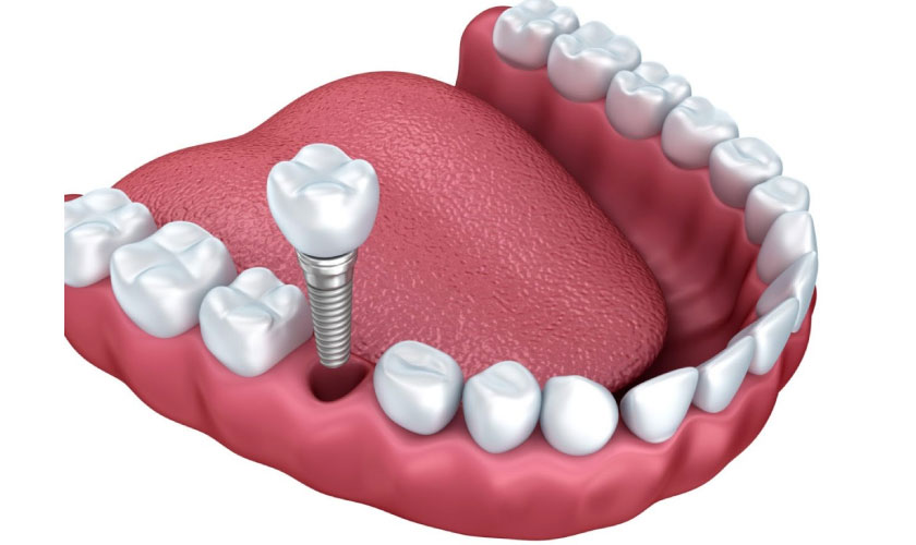 Trồng răng implant là giải pháp phục hình răng mất hoàn hảo
