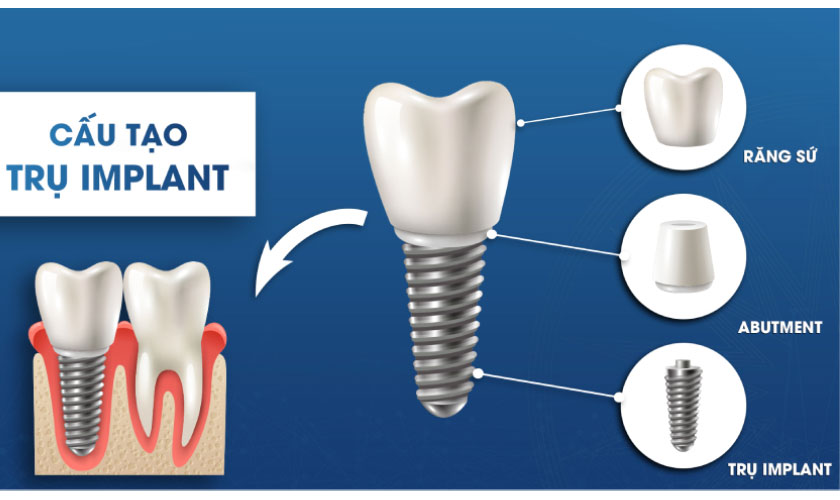 Chi phí implant được tính dựa trên các thành phần cấu tạo nên răng implant