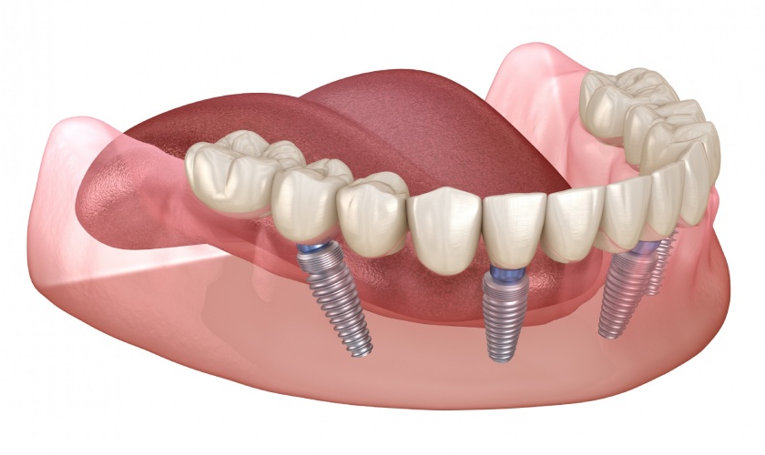 Kỹ thuật cấy ghép implant All on 6 Kỹ thuật cấy ghép implant All on 6