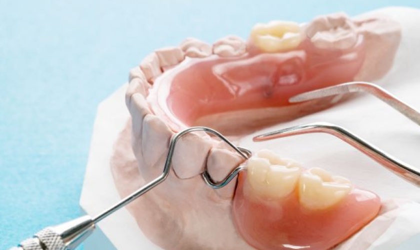 Răng giả tháo lắp sau một thời gian sử dụng sẽ trở nên lỏng lẻo, gây vướng víu, khó chịu