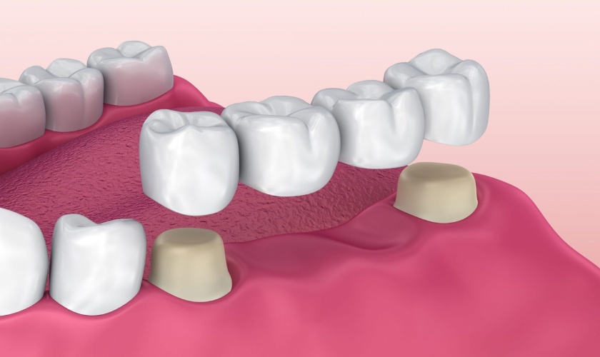 Cầu răng sứ cần phải mài răng hai bên để làm trụ nâng đỡ cầu răng