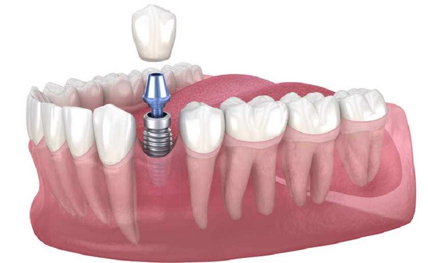 Nên trồng răng Implant càng sớm càng tốt sau khi mất răng