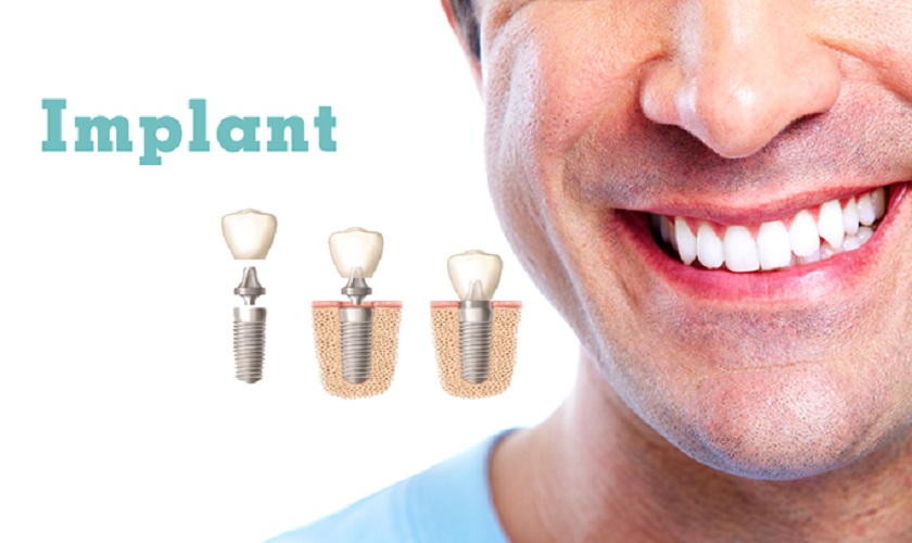 Kinh nghiệm trồng răng Implant – những điều biết và cân nhắc