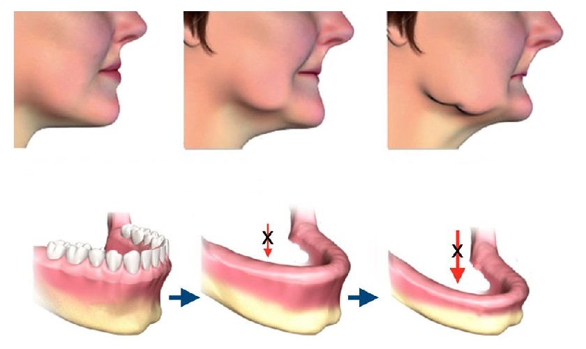 Tiêu xương hàm là hậu quả nghiêm trọng và khó phục hồi
