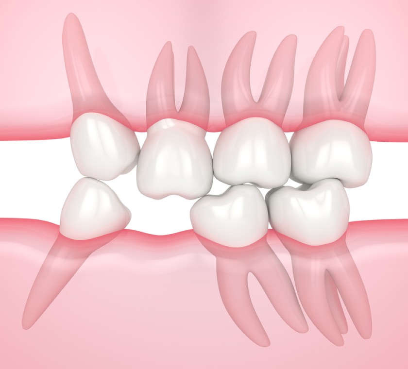 Mất răng khiến hàm răng bị xô lệch