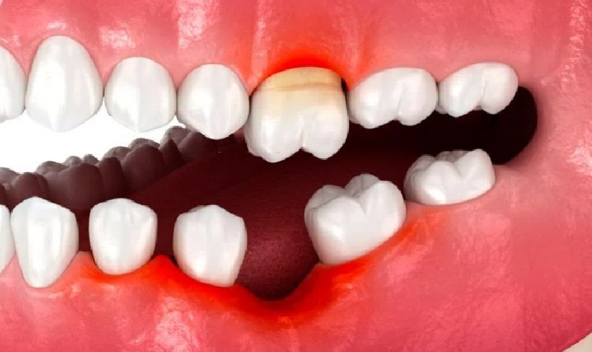 Nguy cơ mắc bệnh răng miệng khi mất răng không được phục hồi kịp thời