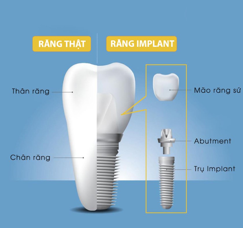 Trồng răng Implant là phương pháp phục hồi răng tối ưu với nhiều ưu điểm vượt trội