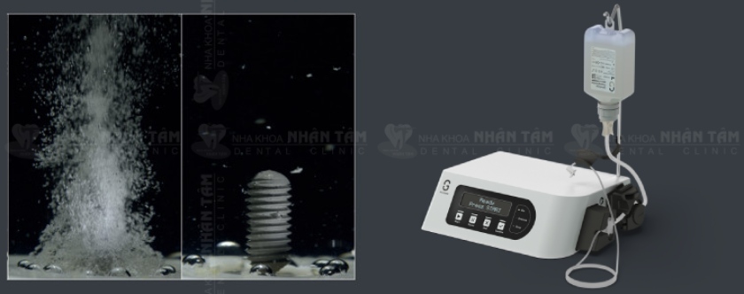 Hệ thống GalvoSurge với công nghệ điện phân giúp loại bỏ màng sinh học, khử nhiễm bề mặt Implant chỉ trong 2 phút Hệ thống GalvoSurge với công nghệ điện phân giúp loại bỏ màng sinh học, khử nhiễm bề mặt Implant chỉ trong 2 phút