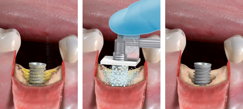 Công nghệ GalvoSurge giúp làm sạch Implant một cách an toàn, hiệu quả và nhanh chóng Công nghệ GalvoSurge giúp làm sạch Implant một cách an toàn, hiệu quả và nhanh chóng