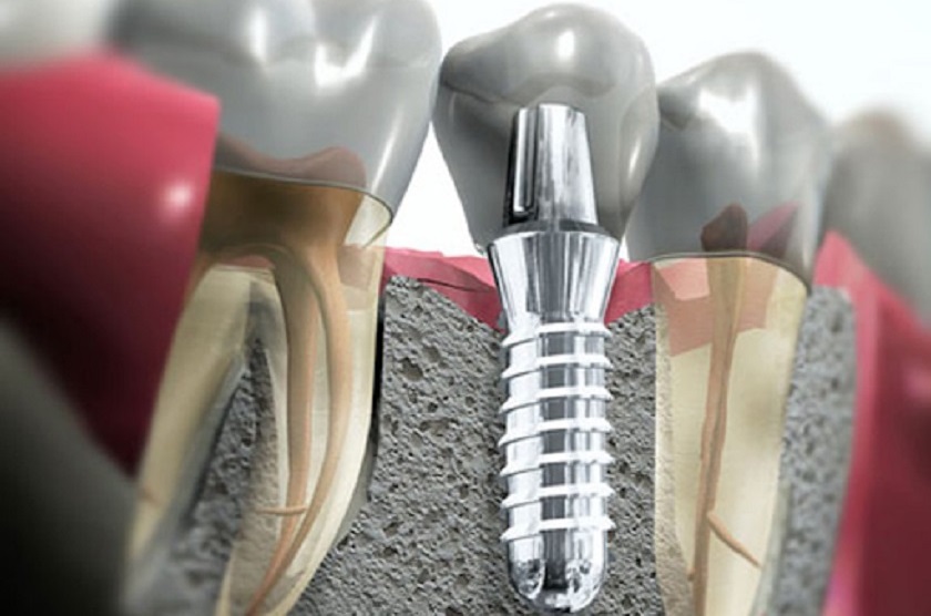 Trồng răng Implant là biện pháp duy nhất có thể ngăn ngừa các biến chứng nguy hiểm do mất răng