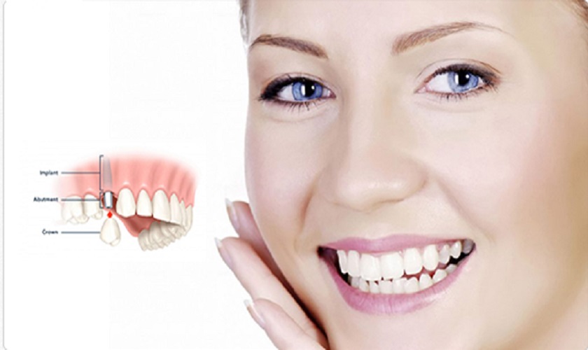 Review trồng răng Implant: Hiệu quả vượt trội giá cả hợp lý