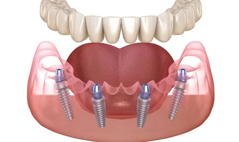 Hàm tháo lắp trên Implant có thanh bar