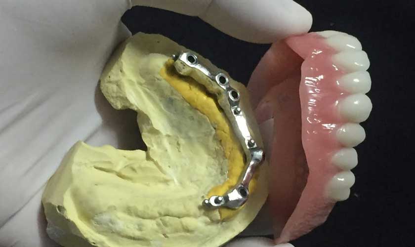 Răng giả tháo lắp trên Implant mang lại nhiều ưu điểm vượt trội