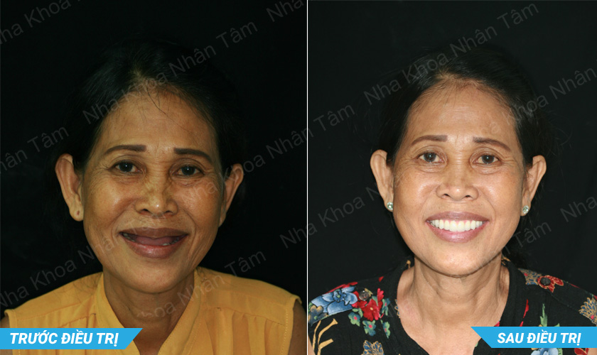 Phục hồi răng mất cho bệnh nhân bằng cấy ghép Implant