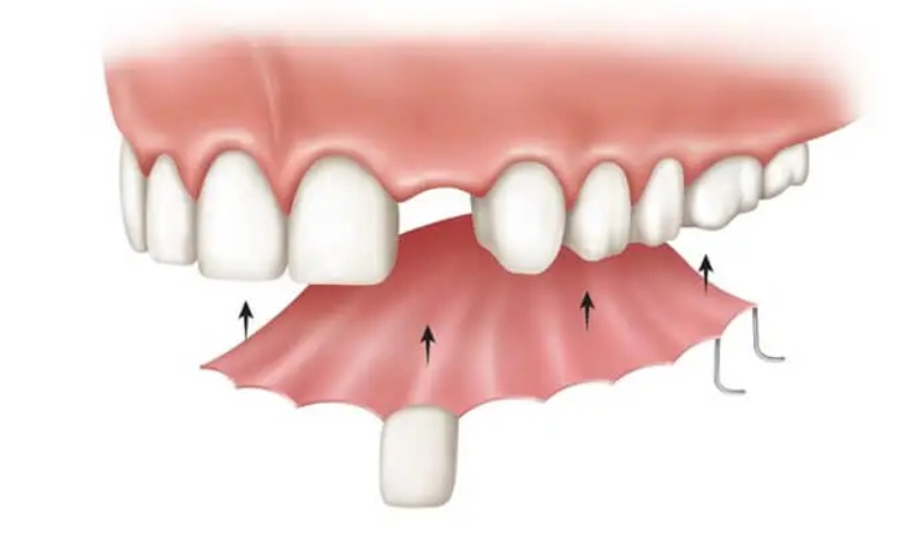 Răng giả tháo lắp là phương pháp trồng răng cổ điển