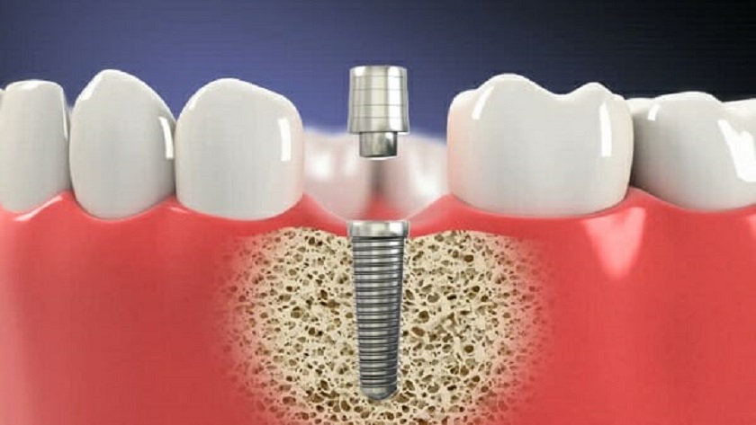 Trồng răng giả Implant bao nhiêu tiền?