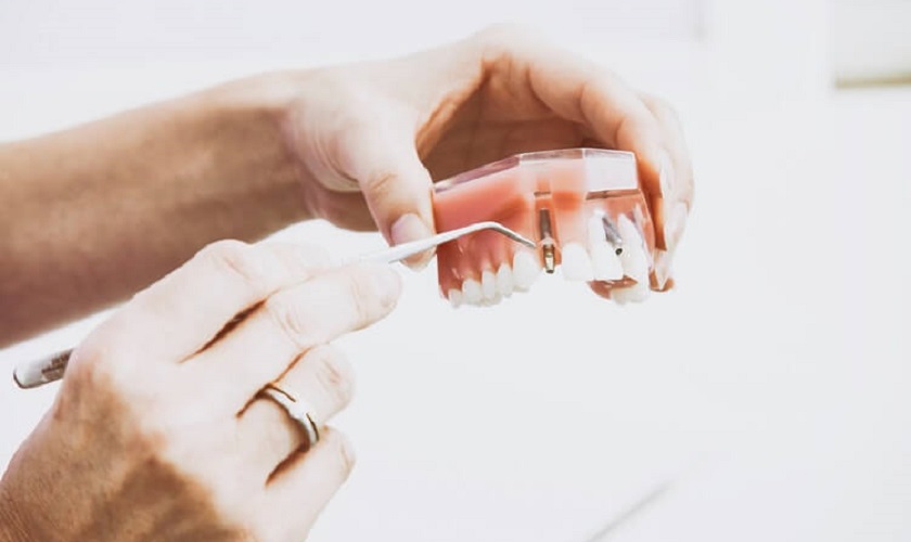 Trồng răng giả Implant bao nhiêu tiền? Có mắc không?