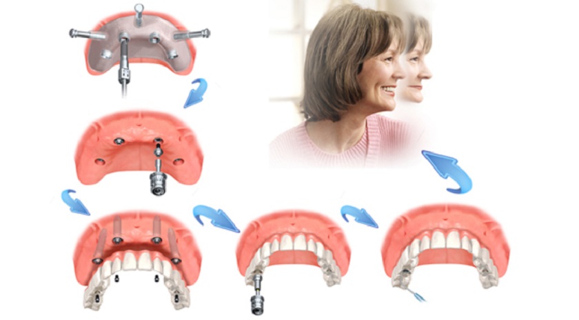 Kỹ thuật trồng răng Implant all on 4