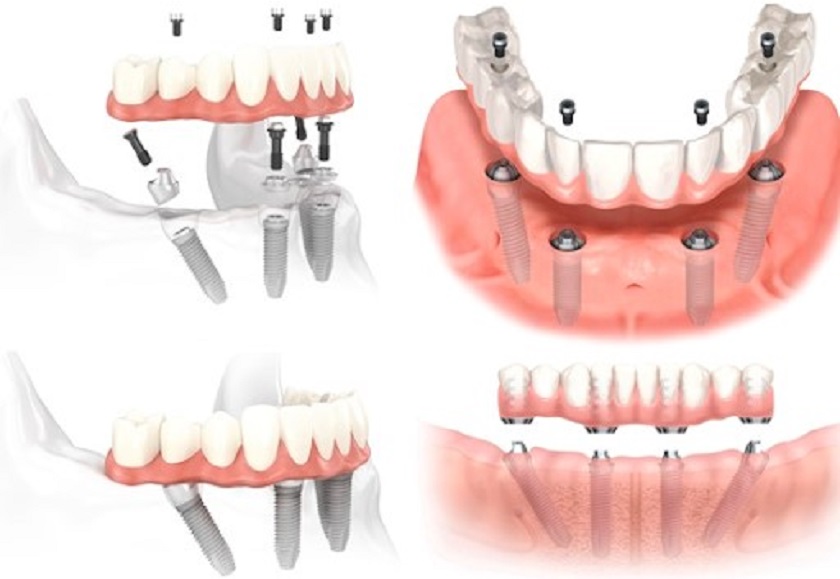 Hình ảnh mô phỏng kỹ thuật trồng răng Implant all on 4