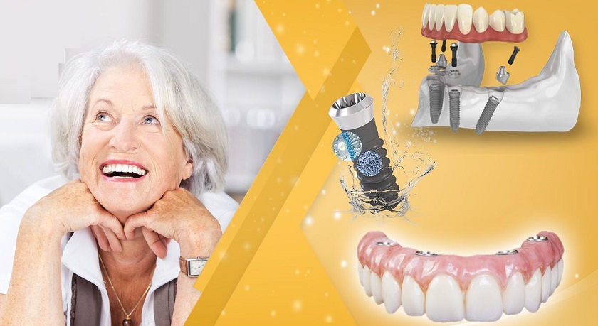 Trồng răng Implant all on 4 khôi phục hoàn hảo tính thẩm mỹ của hàm răng