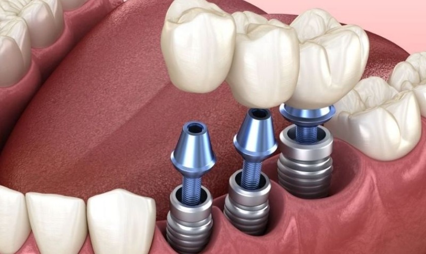Chi phí trồng răng implant phụ thuộc vào nhiều yếu tố