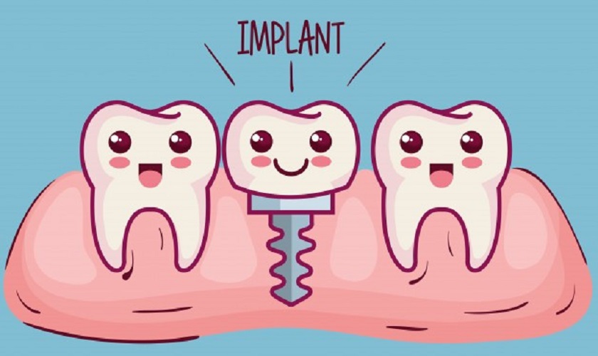 Trồng răng Implant có tốt không? Chi phí bao nhiêu?