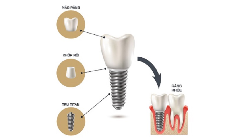 Răng Implant với cấu tạo giống như răng thật