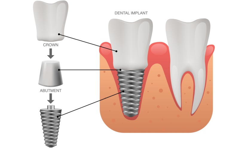 Trồng răng implant là gì là thắc mắc của nhiều người
