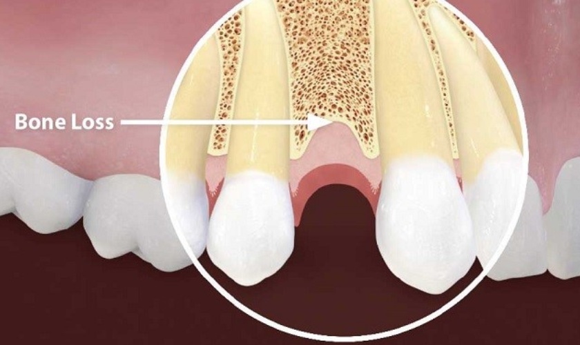 Implant ngăn ngừa tiêu xương hàm hiệu quả