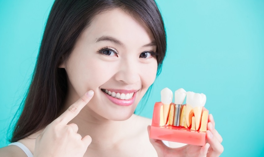Răng implant có độ bền lâu dài