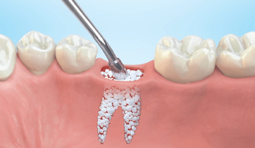 Trồng răng muộn khi xương hàm đã tiêu biến sẽ tốn thêm chi phí cho dịch vụ ghép xương
