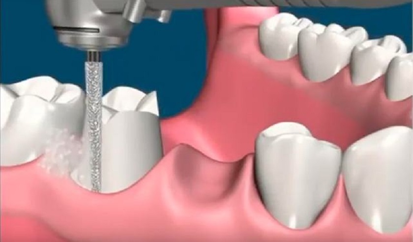 Mài răng trong kỹ thuật làm cầu răng sứ