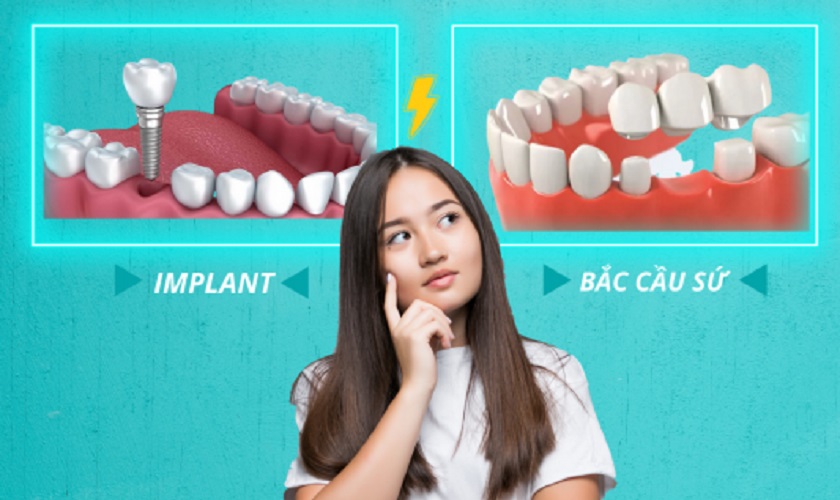 Trồng răng Implant và cầu răng sứ loại nào tốt hơn?