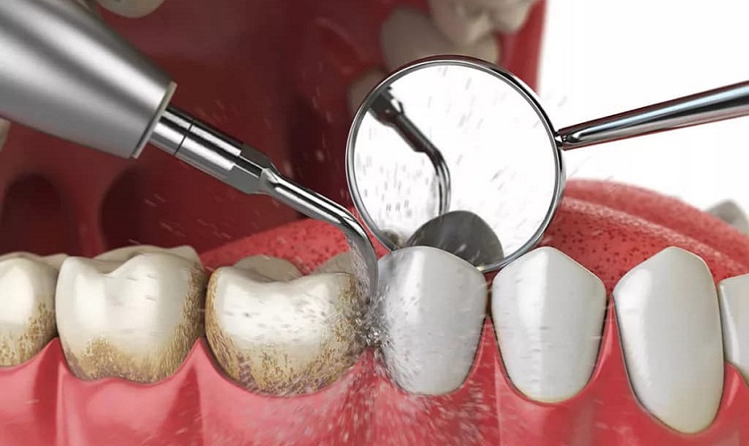 Cạo vôi răng giúp lấy lại hàm răng sạch sẽ một cách nhanh chóng
