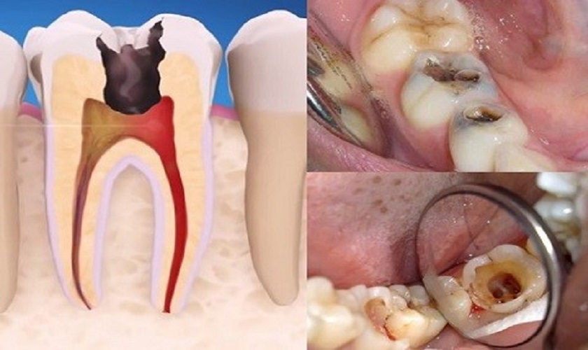 Đau Nhức Chân Răng: Nguyên Nhân và Giải Pháp Hiệu Quả