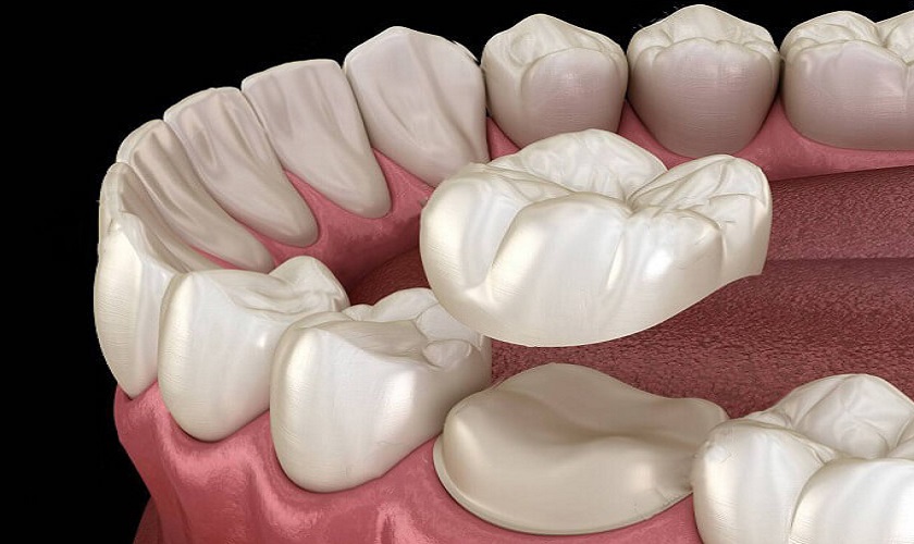 Nên bọc răng sứ khi răng bị vỡ mẻ lớn hoặc đã điều trị tủy