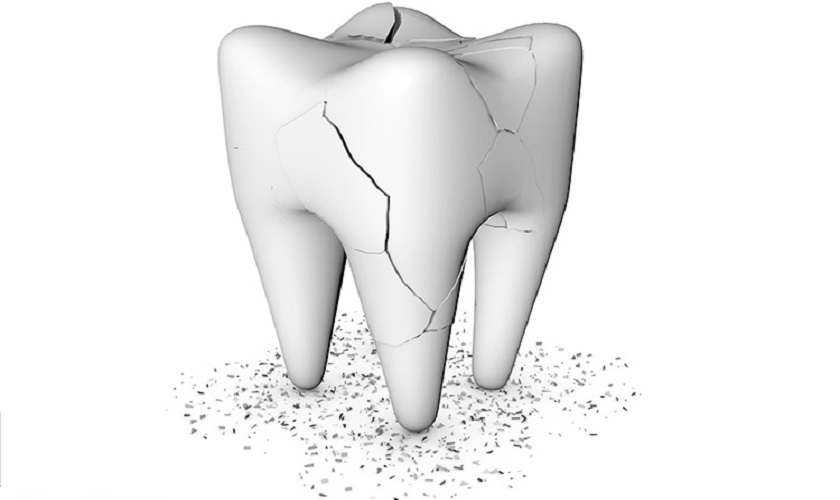 Cần làm gì để khắc phục mẻ răng hàm?