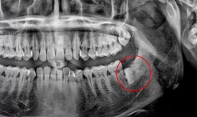 Răng khôn có thể nằm ẩn trong xương hàm
