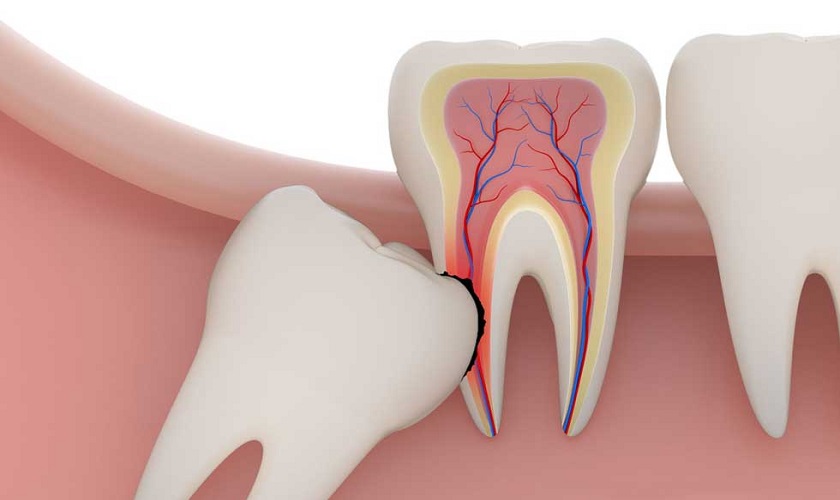 Răng khôn mọc lệch là tình trạng rất hay gặp phải<