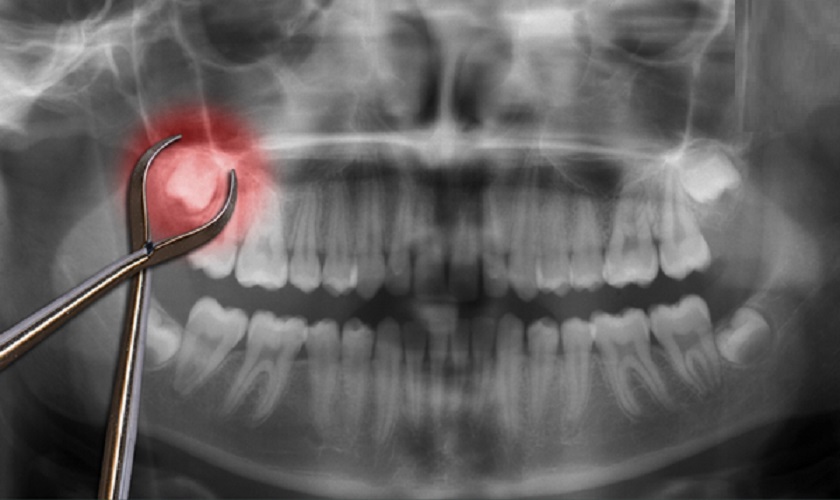 Nên nhổ răng khôn sớm nếu chúng mọc ngầm