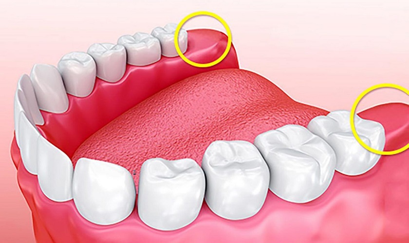 Không mọc răng khôn có nguy hiểm không? Có cần điều trị không?